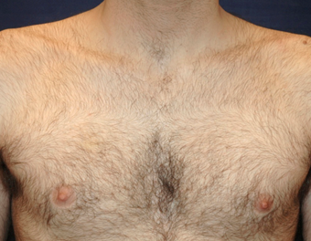 before restylane-injection treatments_laugh line