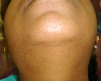 after results of restylane-injections-face treatment