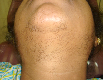 Before restylane-injection-skin rejuvenation dr.