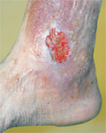 Venous ulcer Venous ulcer
