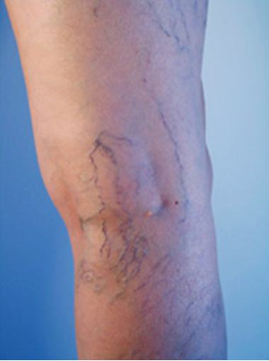 Spider Veins