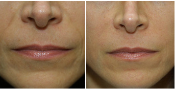 Radiesse-skin-treatment Radiesse-skin-treatment