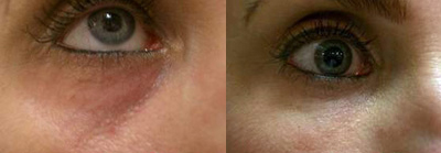 Radiesse-skin treatment-results Radiesse-skin treatment-results