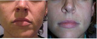 Radiesse_eye treatments Radiesse_eye treatments