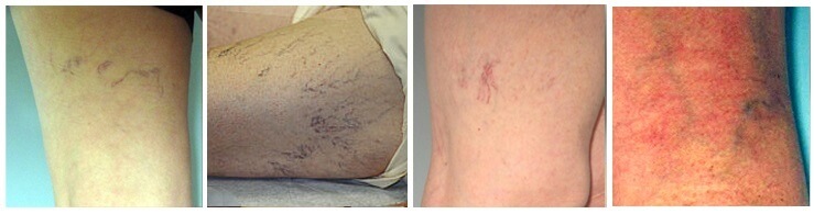 Spider veins picture showing the difference between spider and varicose veins.