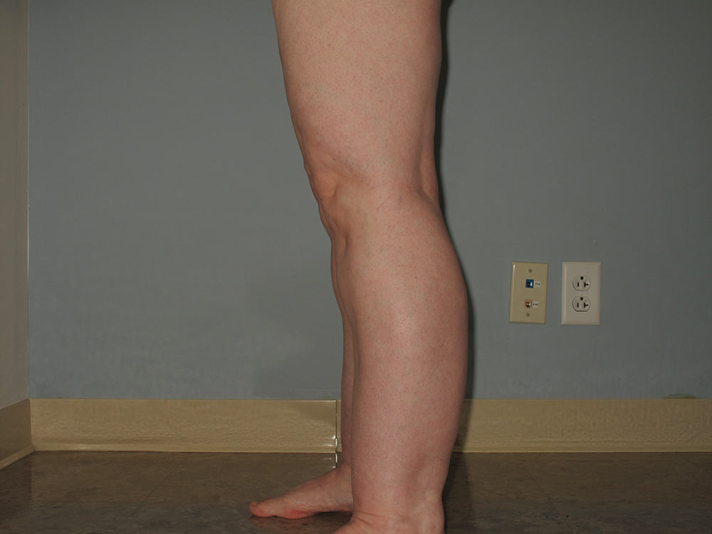 Learn About Lipo for Lipedema Laser Lipo and Vein Center