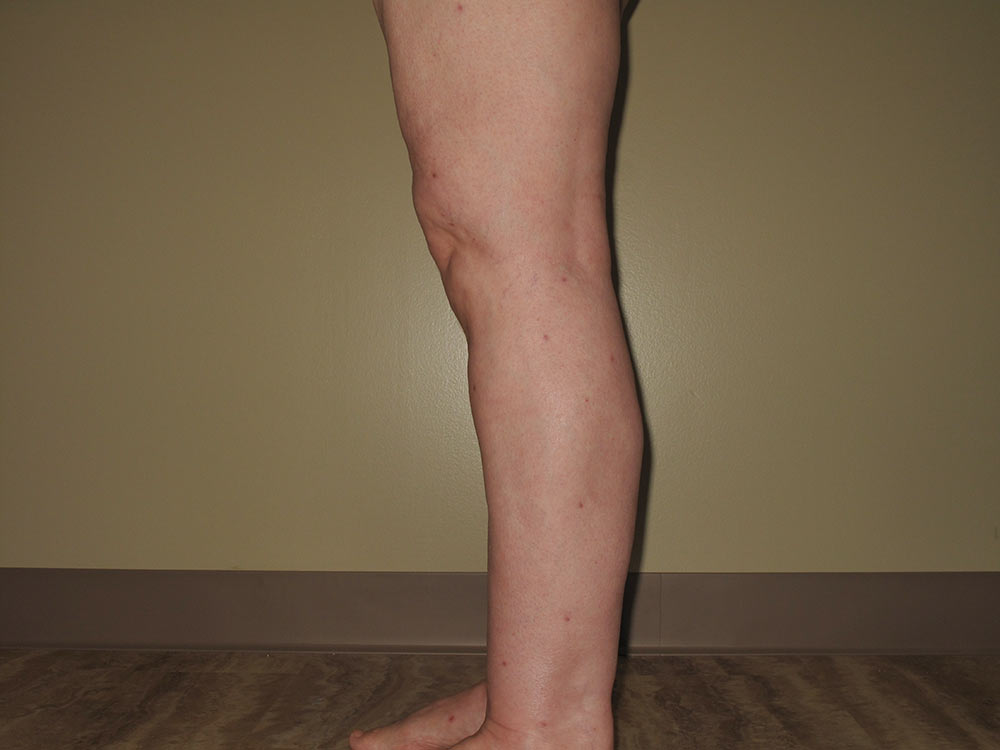 Learn About Lipo for Lipedema Laser Lipo and Vein Center