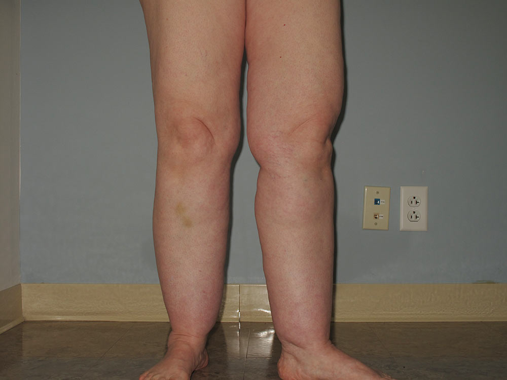 Liposuction for Lipedema How Does Lipedema Liposuction