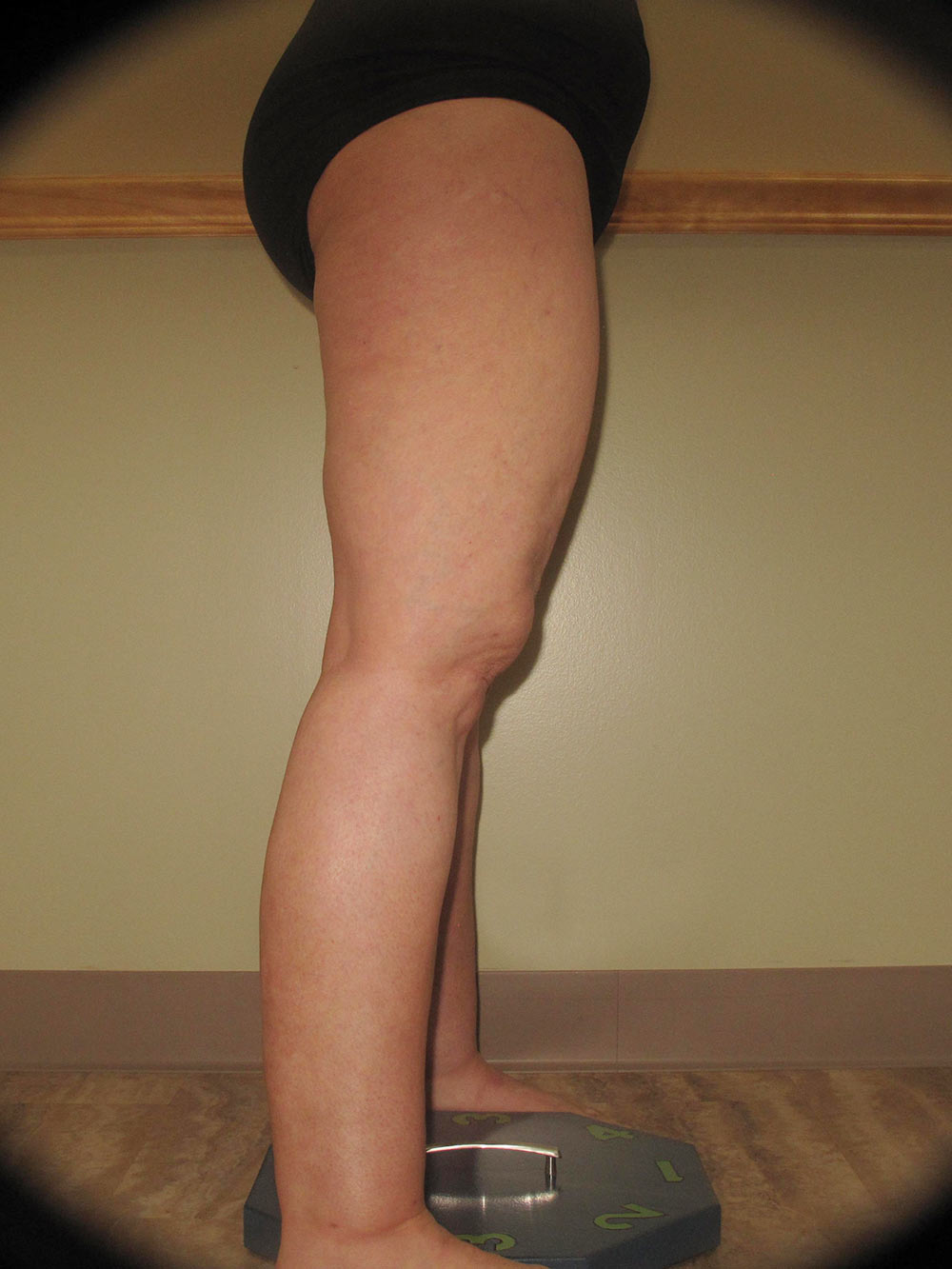 Liposuction for Lipedema| How Does Lipedema Liposuction Work? | Laser