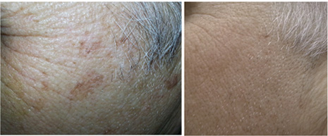 Before and After St Louis Photo Skin Rejuvenation Before and After St Louis Photo Skin Rejuvenation