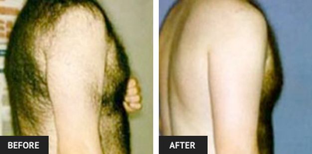 Laser Hair Removal Before And After Pictures Laser Lipo Vein