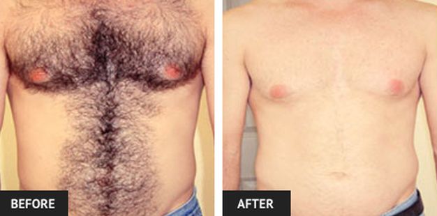 Laser Hair Removal Before And After Pictures Laser Lipo Vein
