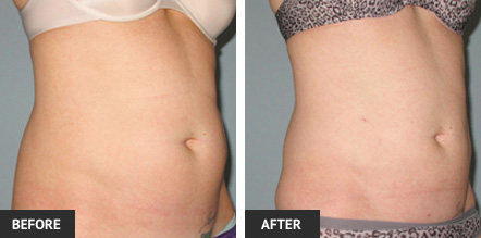 Liposuction before and after pictures of the Abdomen on one of our St. Louis lipo patients.