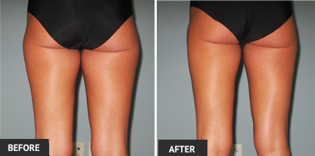 Outer thighs are much more shapely after liposuction. Check her before and after liposuction results.