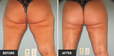 Inner thighs greatly benefit from sculpting with liposuction. Note the liposuction results in the before and after photos.