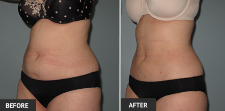 Liposuction before and after photos of the Abdomen performed by Dr. Wright.