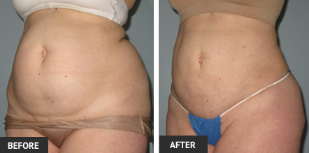 Get great liposuction results with Abdominal Liposuction.