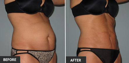 One of our St. Louis patients with hard-to-lose abdominal fat after liposuction. Note their liposuction results.