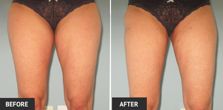 A excellent liposuction results with one of our St. Louis patients after outer thigh liposuction.
