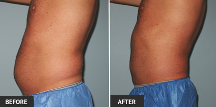 Liposuction before and after photos of the Abdomen on our St. Louis patient brought great results.