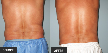 Before and after photo of our male St. Louis patients with a greatly improved shape after liposuction on flanks.