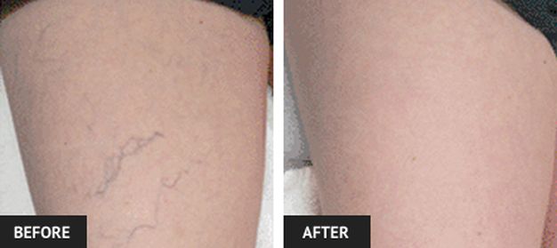Before and After Vein Treatment