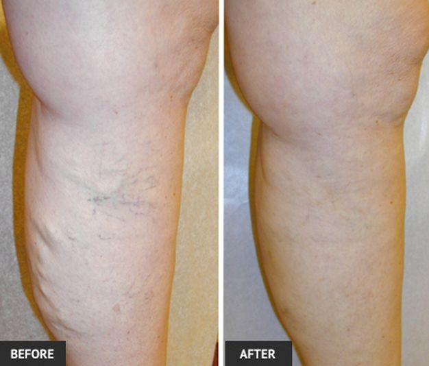 Natural Way To Get Rid Of Spider Veins On Face Natural Way To Get Rid Of Spider Veins On Face