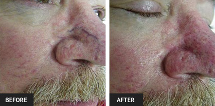 Blue vein on nose after one vein treatment with sclerotherapy. Before and After Photos.