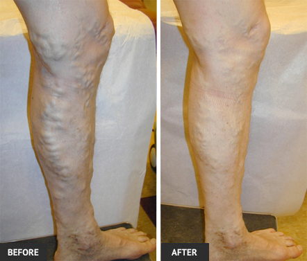 Very painful veins are easily treated with symptoms subsiding quickly. vein treatment before and after