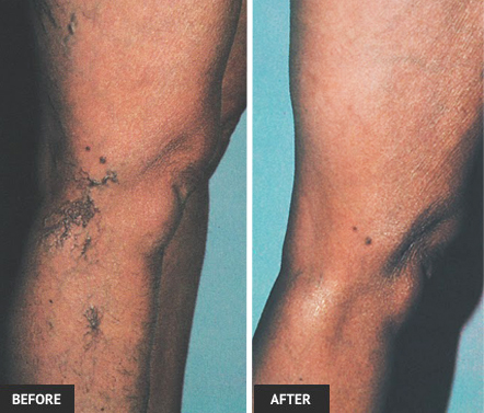 Painful veins are not just a cosmetic issue. Left untreated, veins will worsen. Get vein treatment at our St. Louis vein center.
