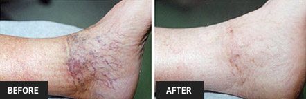 Ankle with spider veins mostly gone after several sclerotherapy vein treatments.