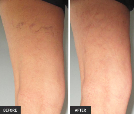 Vein removal before and after photo of veins treated with sclerotherapy in our St. Louis vein center.