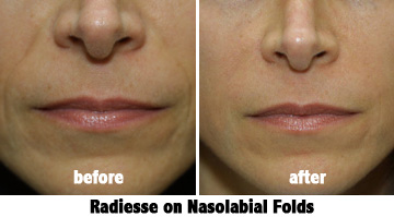 Before and after radiesse dermal face and lip fillers Radiesse before and after