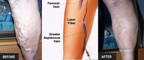 Endovenuous Laser Treatment Before and After with Diagram Endovenuous Laser Treatment Before and After with Diagram