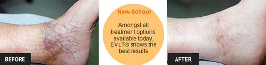 Spider Veins Treatment Results new vein treatment before and after