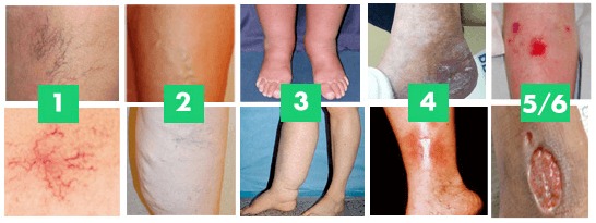 Chronic Venous Insufficiency, Stages of Venous Disease