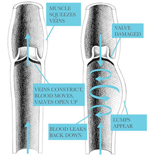 varicose vein disease Diagram of Vein Diseases