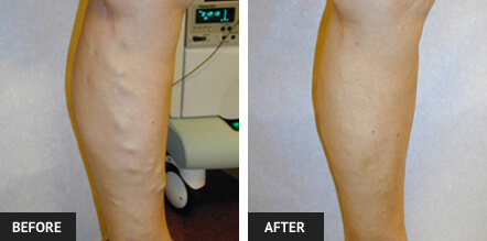 Our Varicose Veins Treatment Results St Luois Varicose Veins Treatment - Before and After