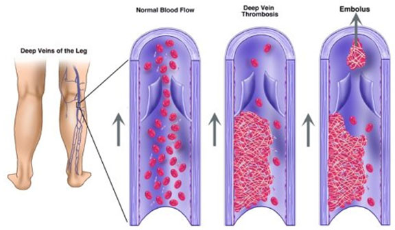 dvt deep vein thrombosis symptoms