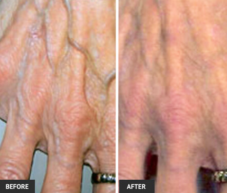 hand vein removal before and after hand vein removal before and after