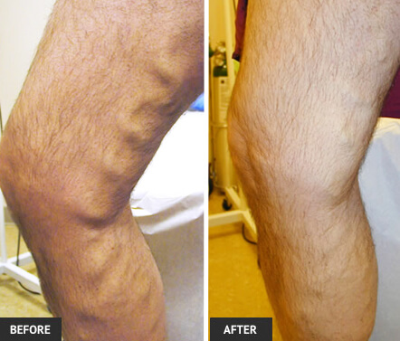 Results of Natural varicose veins treatment natural varicose veins treatment results