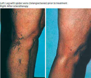 sclerotherapy