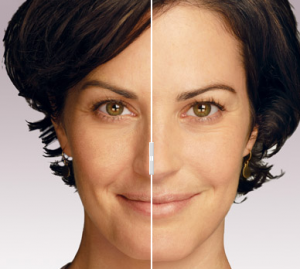 Before and After JUVeDERM 1 Lipotropics