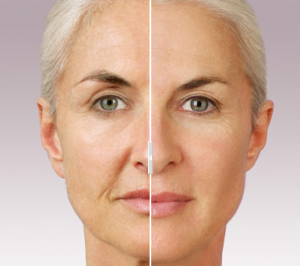 Before and After JUVeDERM 2 laser lipo