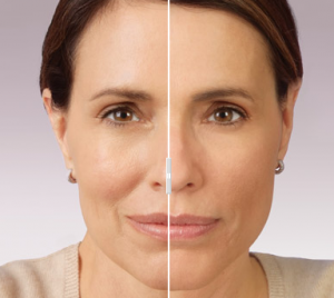 Before and After JUVeDERM 3 lipo laser