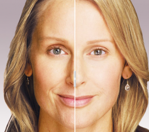 Before and After JUVeDERM lose weight