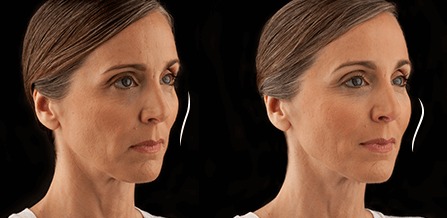 Voluma Filler in St Louis - How it Works voluma filler in St. Louis