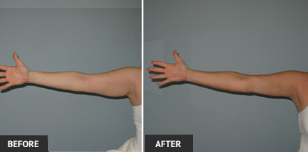 Pic Arm lipo