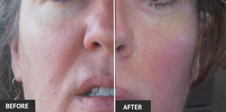 skin laser tightening forma before sagging treatment results louis st lipo ulthera vs vary patient actual individual tighten laserlipoandveins