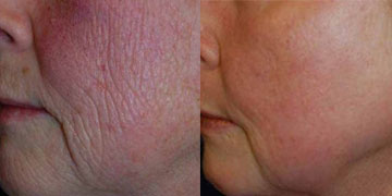 Before and After our St Louis Chemical Peel Treatments Before and After our St Louis Chemical Peel Treatments